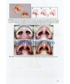 cac van de co ban trong phau thuat tao hinh tham my phan 3 ml5